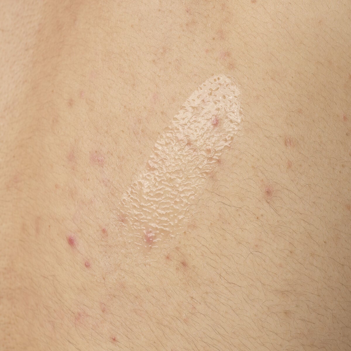 salicylic-acid-0-5-body-serum-x7 ORD-salicylic-acid-05-body-240ml-application.jpg