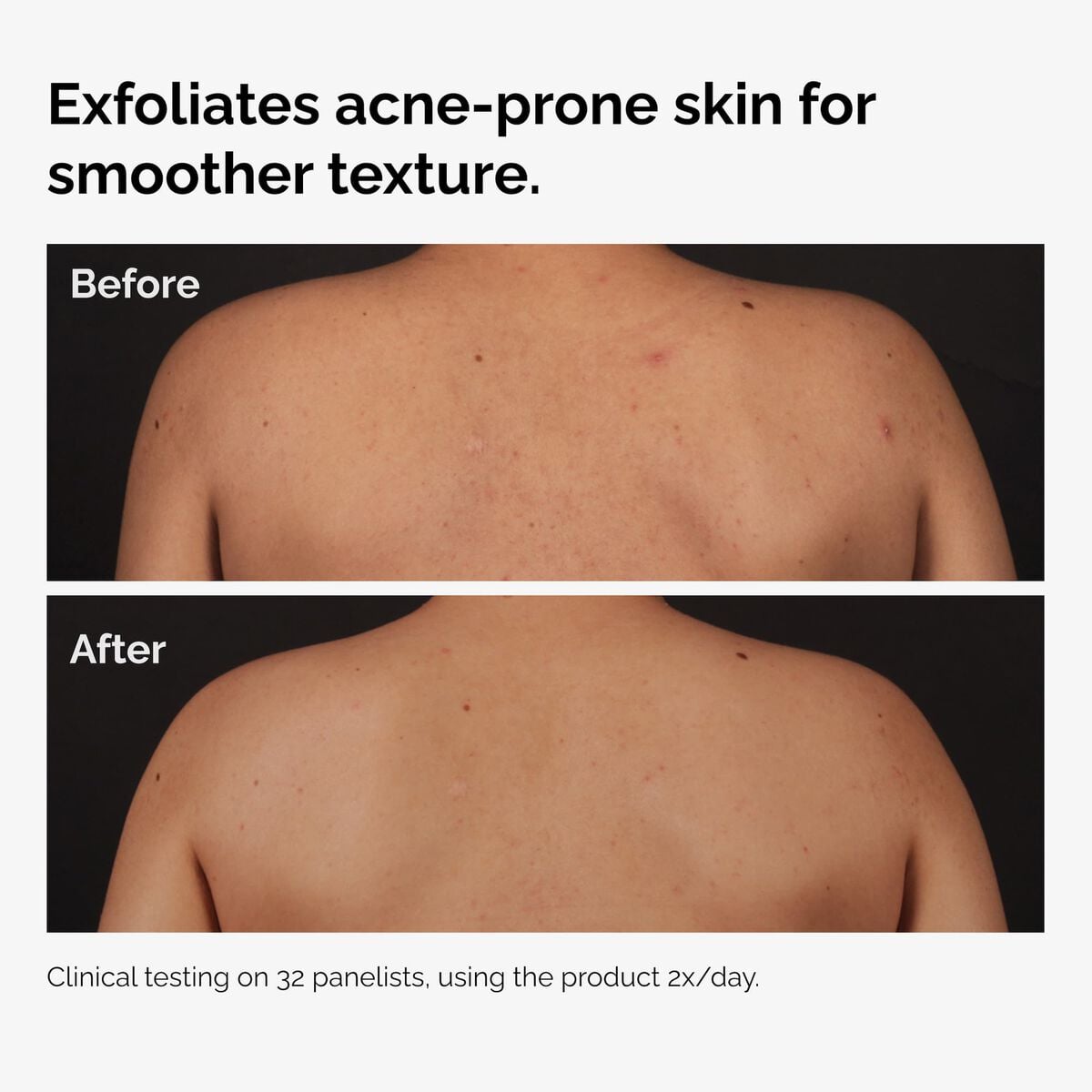 salicylic-acid-0-5-body-serum-x7 ord-salicylic-acid-body-serum-before-after-graphic-NA.jpg