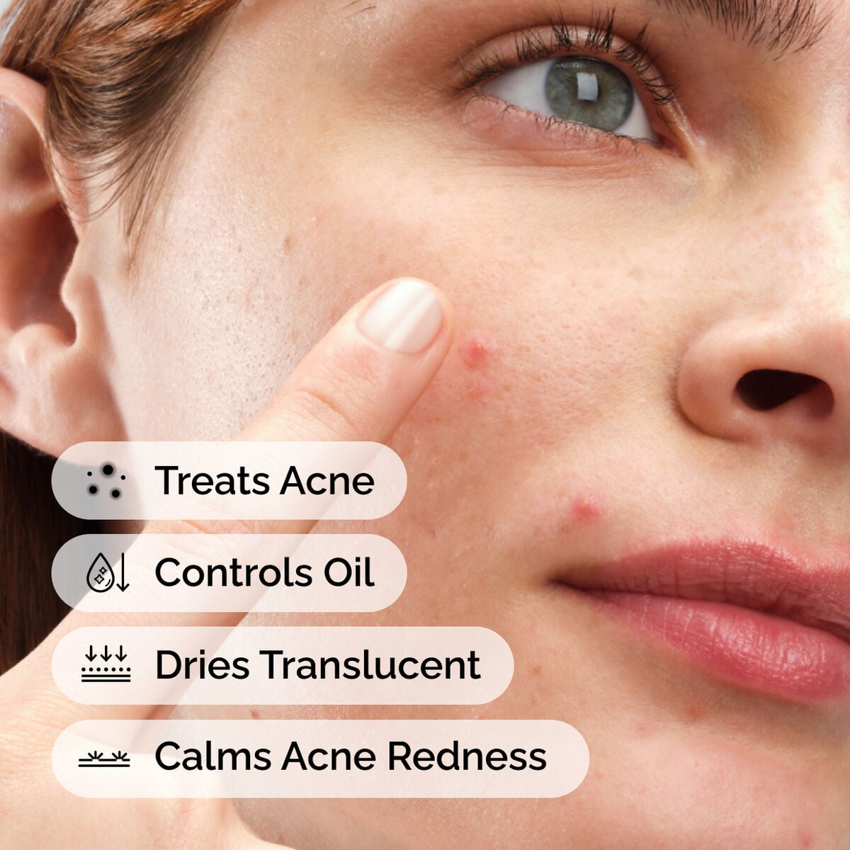 sulfur-10-powder-to-cream-concentrate-r3 ord-sulfur-10pct-powder-to-cream-concentrate-model-application-with-benefits-acne.jpg